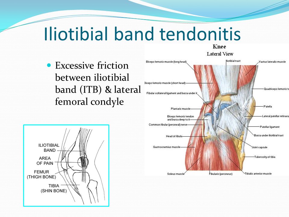 Iliotibial band tendonitis