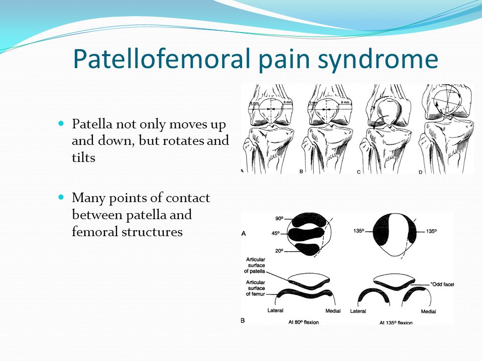 Patellofemoral pain syndrome