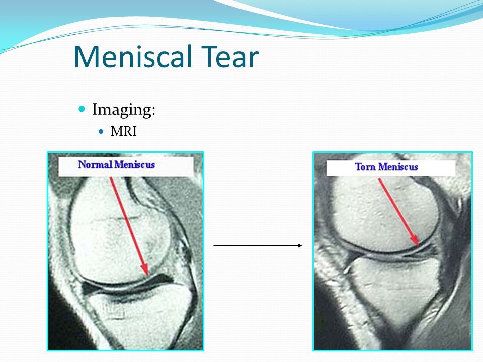 Meniscal Tear Imaging: MRI