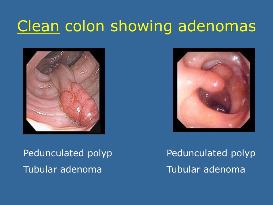 Different types of adenomas