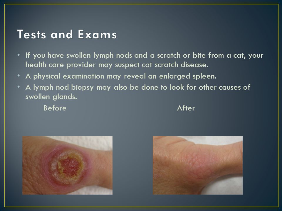 Cat Scratch Disease By Ashley Beamon Ppt Video Online Download
