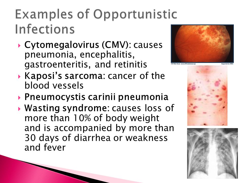 Examples of Opportunistic Infections