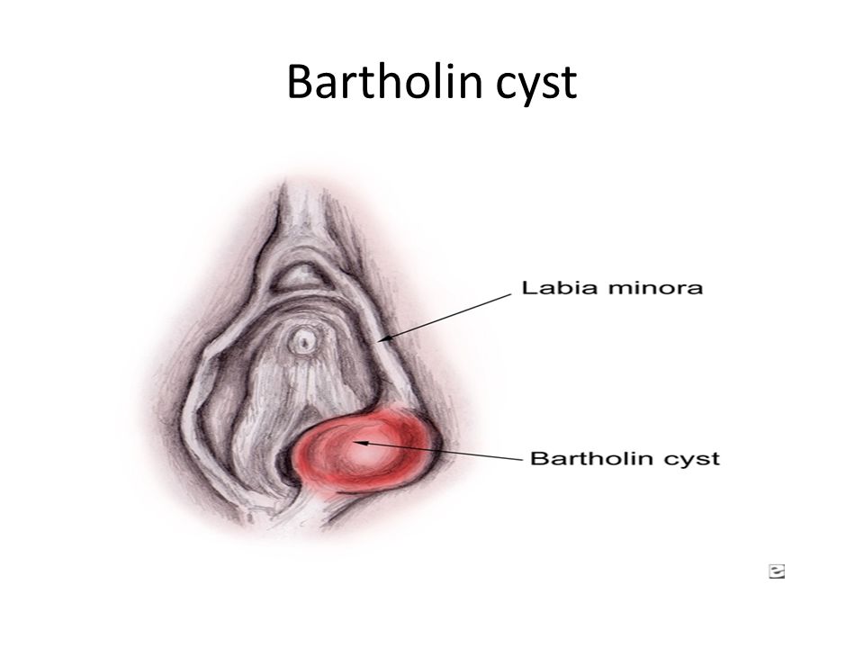 Is bartholin's cyst a sexually transmitted disease