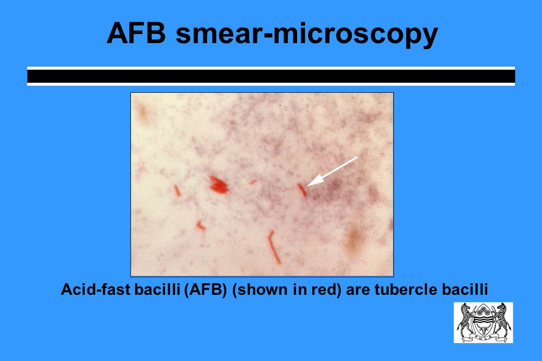 AFB smear-microscopy Acid-fast bacilli (AFB) (shown in red) are tubercle bacilli