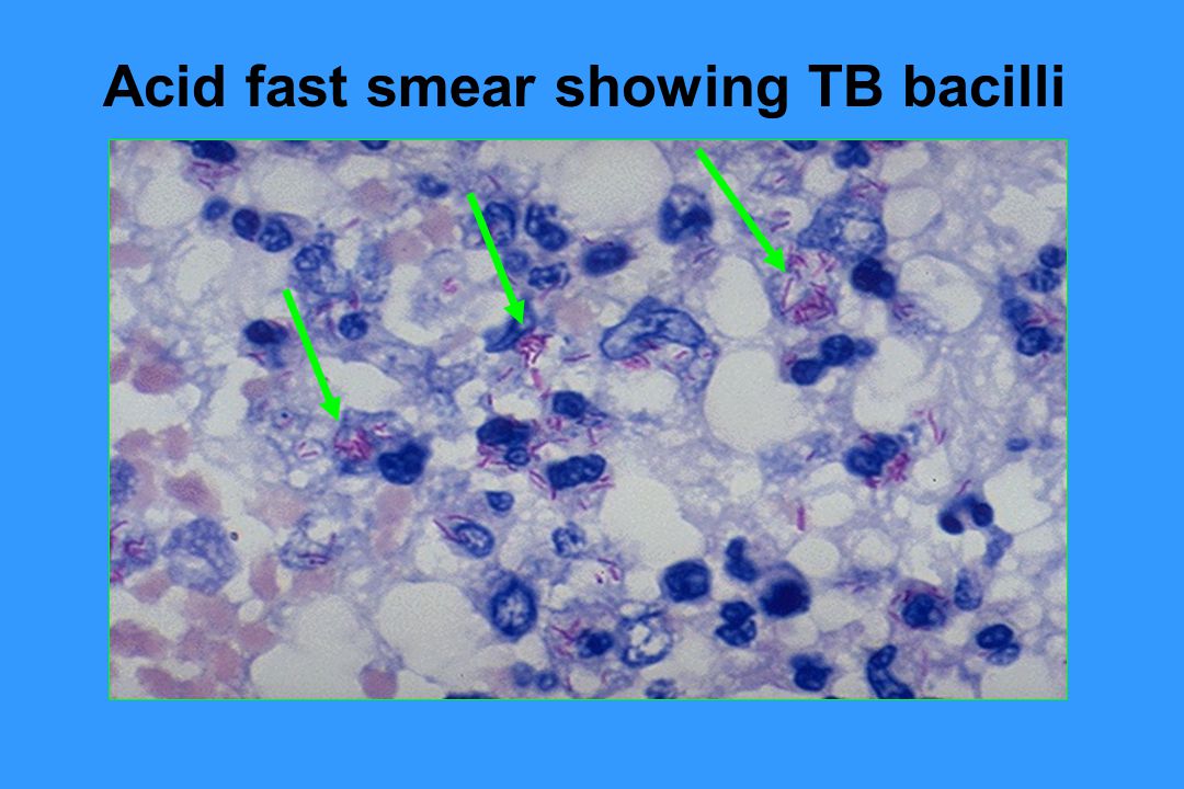 Acid fast smear showing TB bacilli