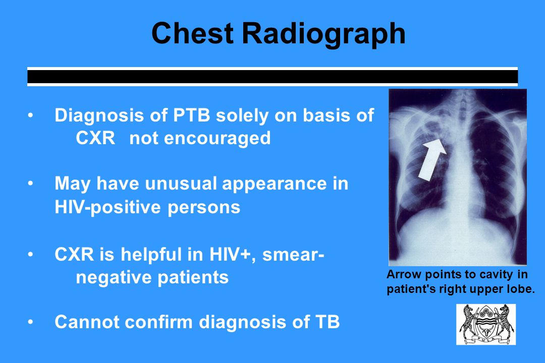 Chest Radiograph Diagnosis of PTB solely on basis of CXR not encouraged. May have unusual appearance in.