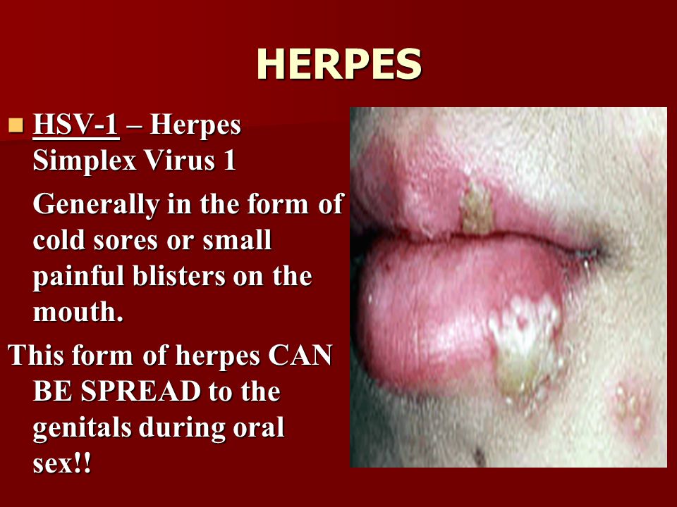 Symptoms Of Genital Herpes