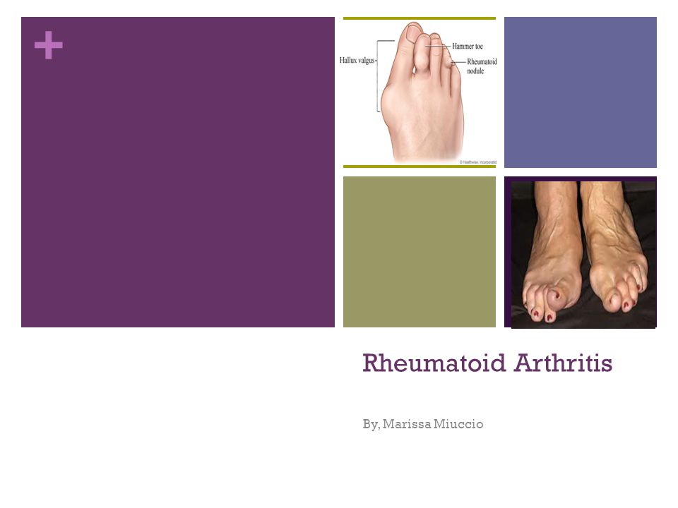 Rheumatoid Arthritis By, Marissa Miuccio