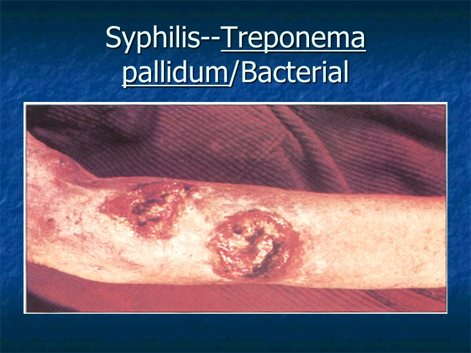 Syphilis--Treponema pallidum/Bacterial