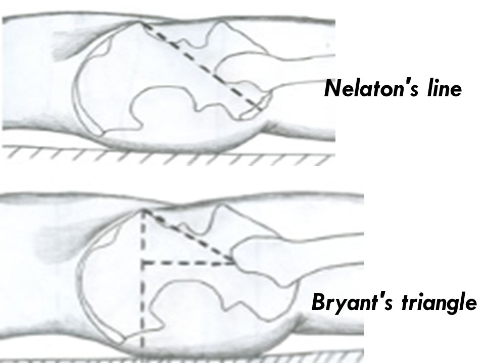 Nelaton s line Bryant s triangle