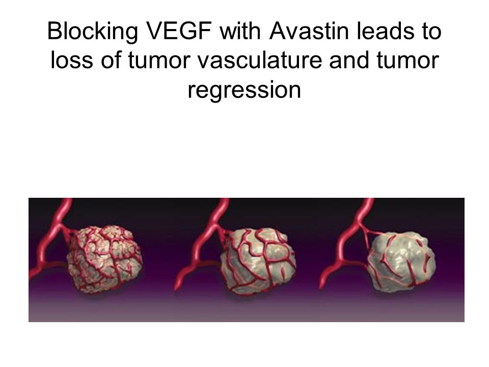 Blocking VEGF with Avastin leads to loss of tumor vasculature and tumor regression