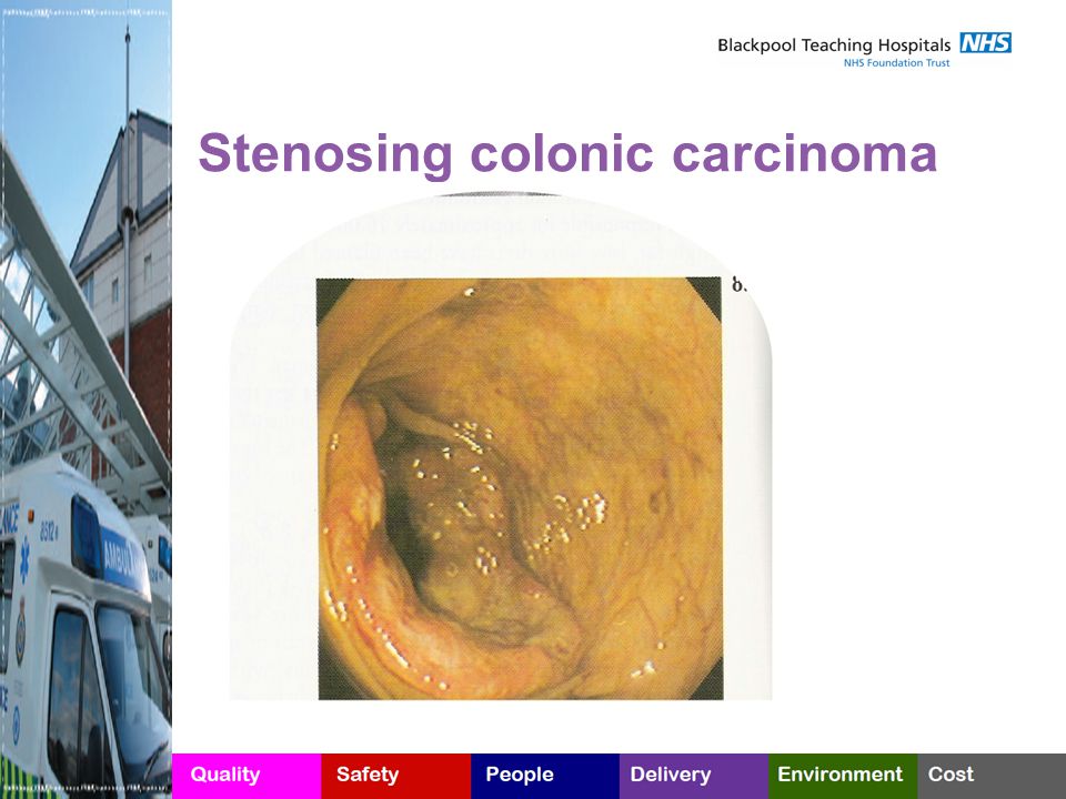 Stenosing colonic carcinoma
