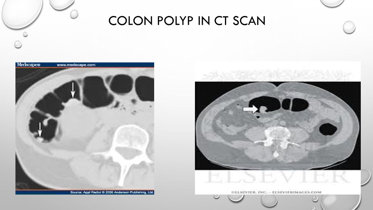 Colon polyp in ct scan