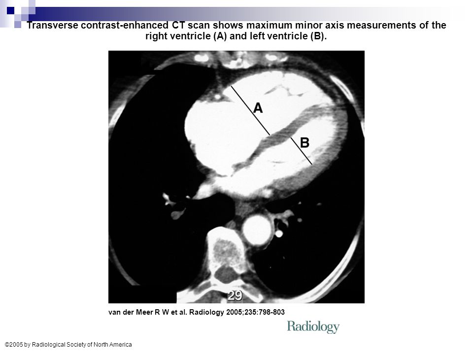 Acute Pulmonary Embolism Diagnosis And Management Ppt Video Online Download