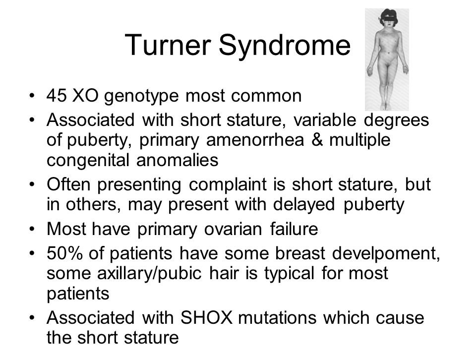 Turner Syndrome 45 XO genotype most common.