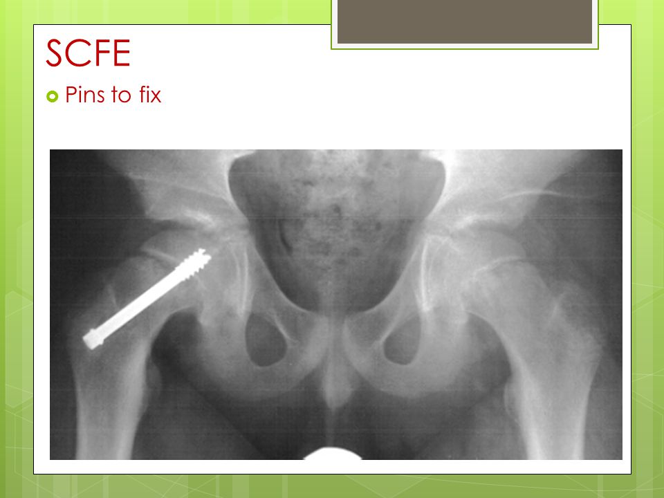 Presentation on theme: "Anatomy & Injuries to the Thigh, Hip and P...