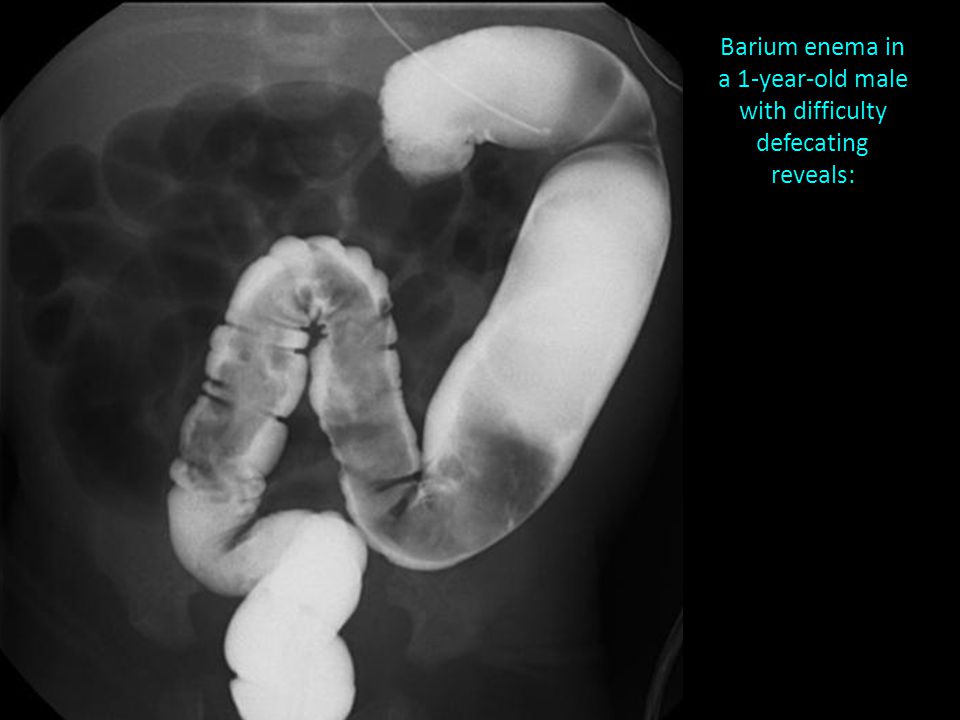 Barium enema in a 1-year-old male with difficulty defecating reveals: