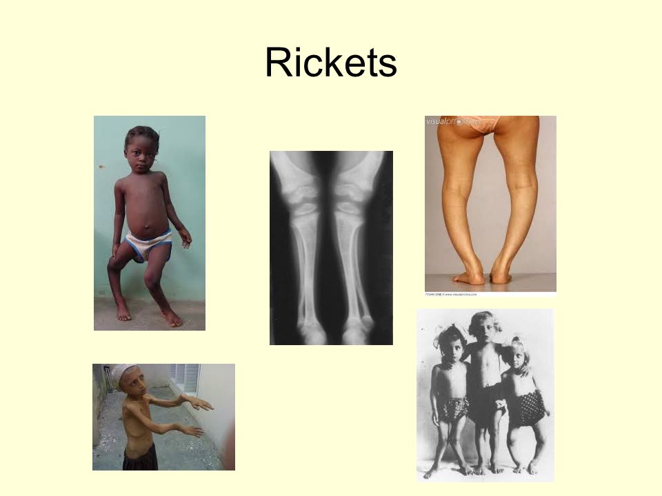 Rickets