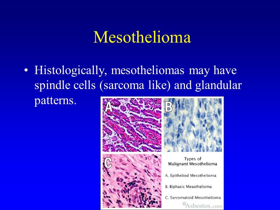 Tumors Of The Lung And Upper Respiratory Tract Ppt Video Online Download