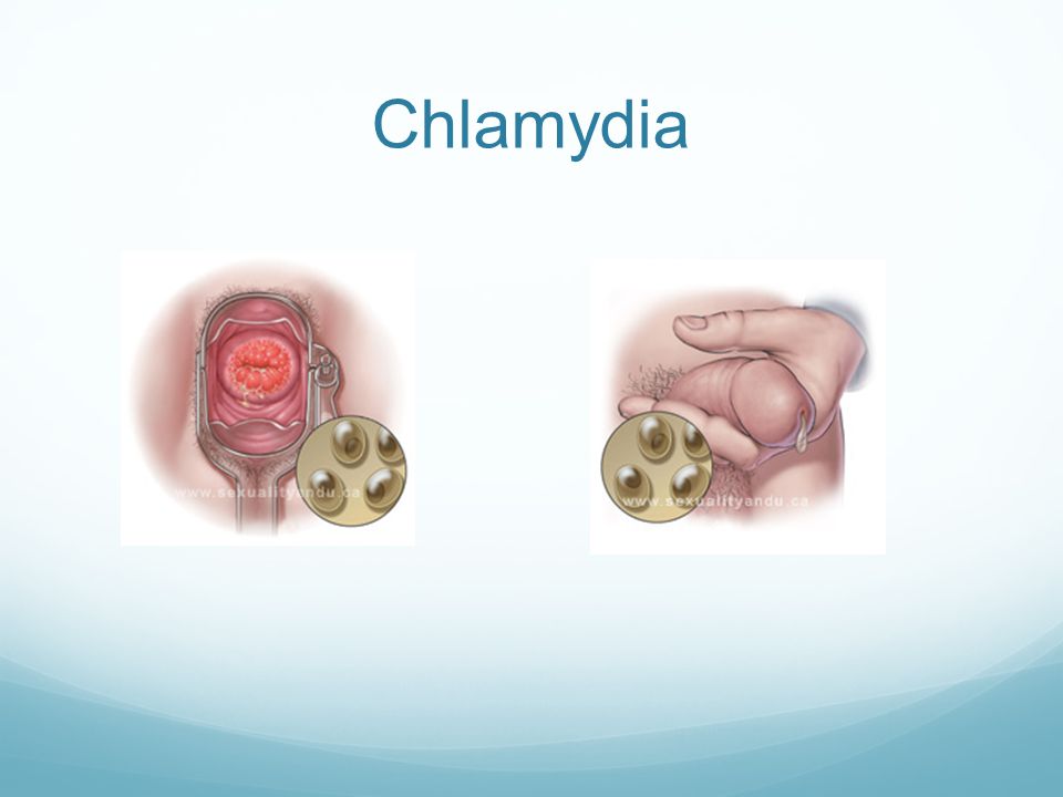 Chlamydia.