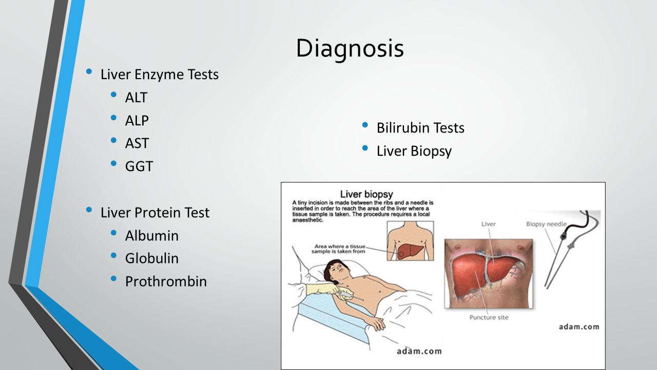 Diagnosis Liver Enzyme Tests ALT ALP Bilirubin Tests AST Liver Biopsy.