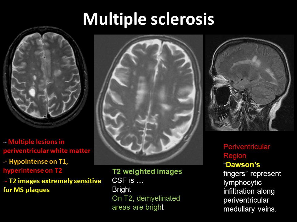 Multiple sclerosis Periventricular Region