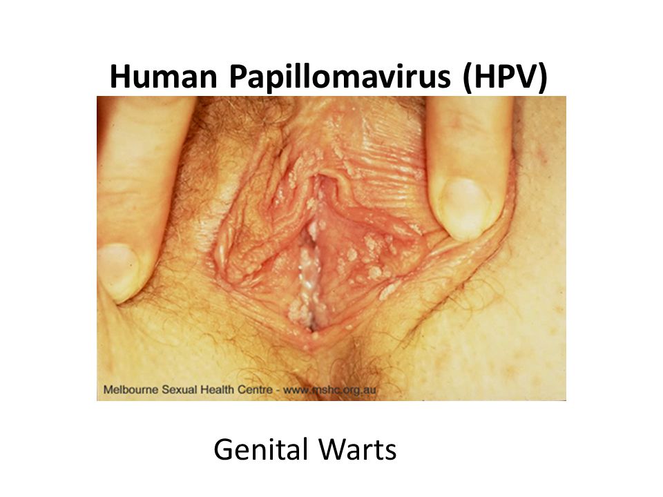 Human Papillomavirus Infection