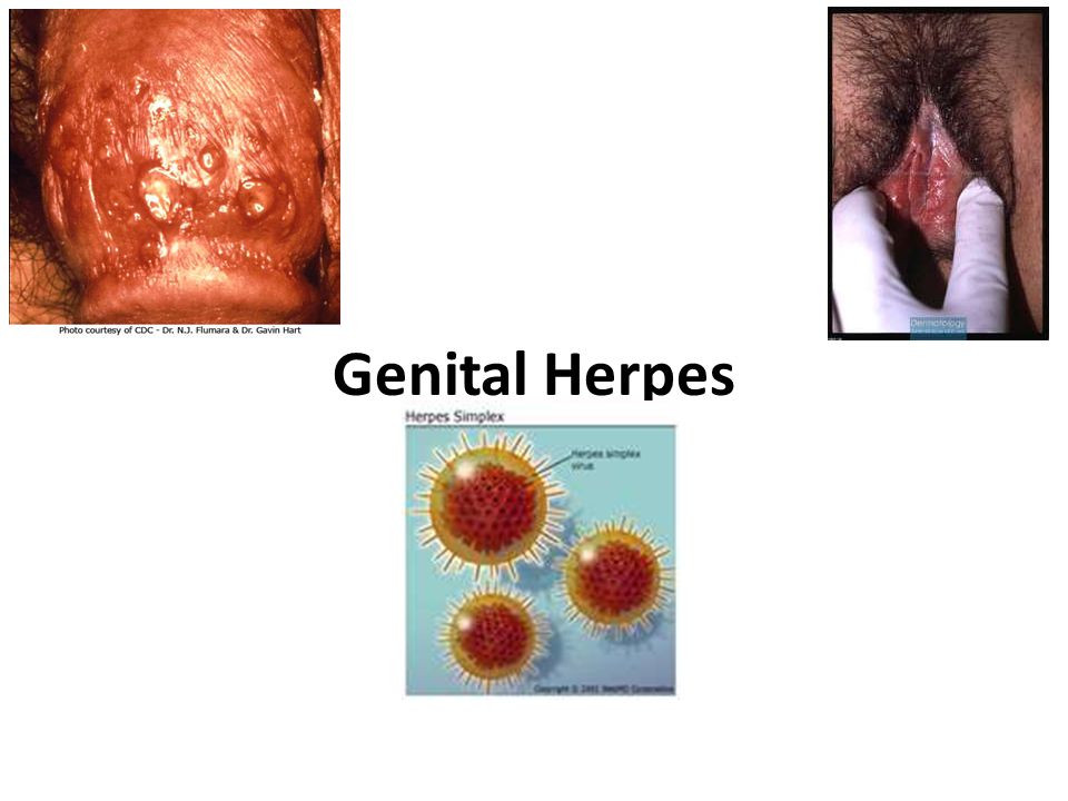 Vaginalis herpes What is