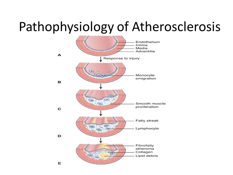 pathogenesis of atherosclerosis flow chart - Trinity