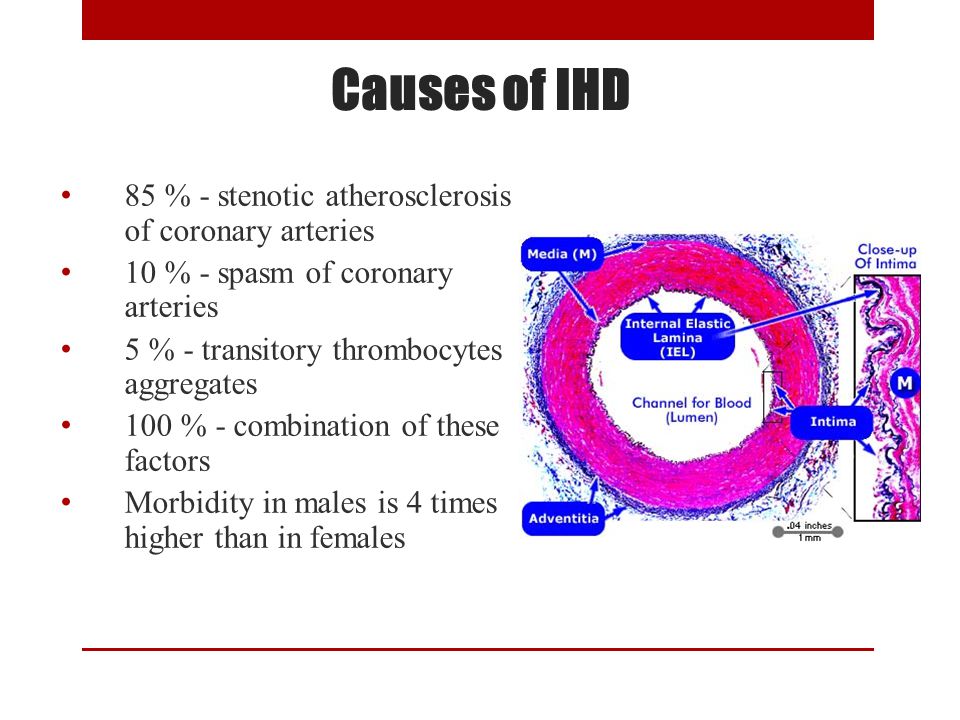 Main Symptoms And Syndromes In Ischemic Heart Disease Ppt Video Online Download