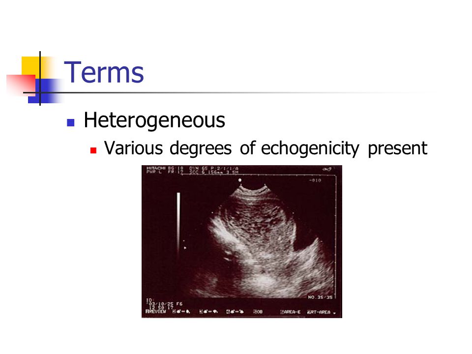Terms Heterogeneous Various degrees of echogenicity present