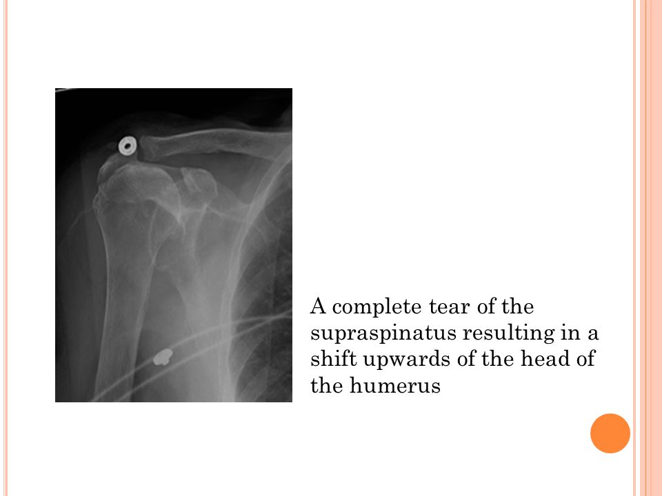 A complete tear of the supraspinatus resulting in a shift upwards of the head of the humerus