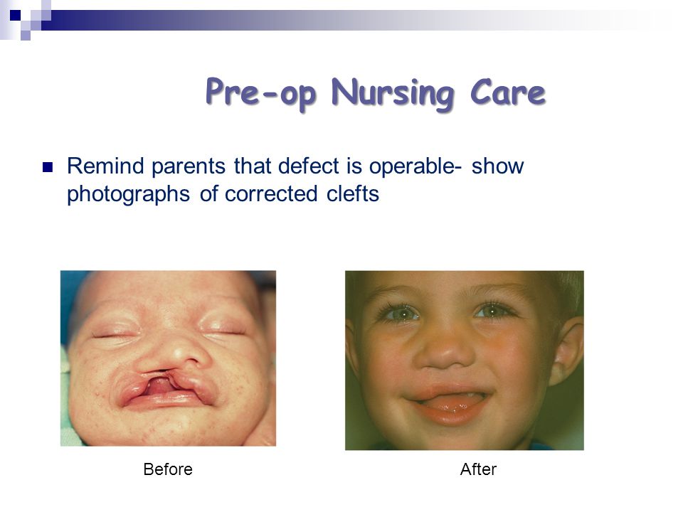 Pre-op Nursing Care Remind parents that defect is operable- show photographs of corrected clefts. Before.