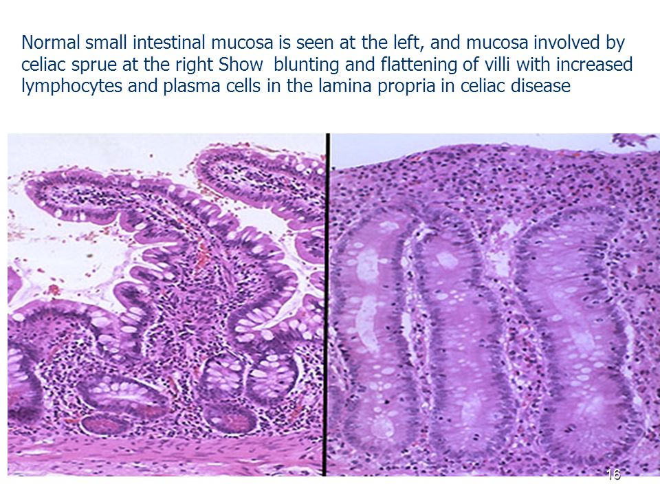 Normal small intestinal mucosa is seen at the left, and mucosa involved by celiac sprue at the right Show blunting and flattening of villi with increased lymphocytes and plasma cells in the lamina propria in celiac disease