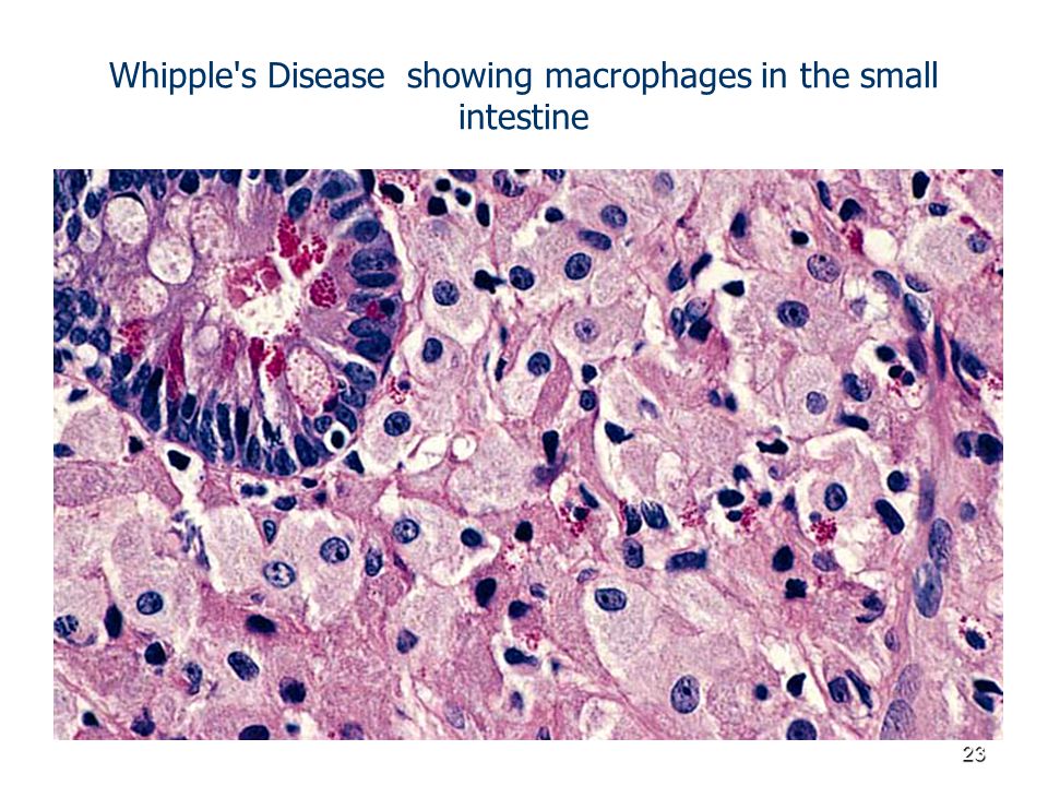 Whipple s Disease showing macrophages in the small intestine