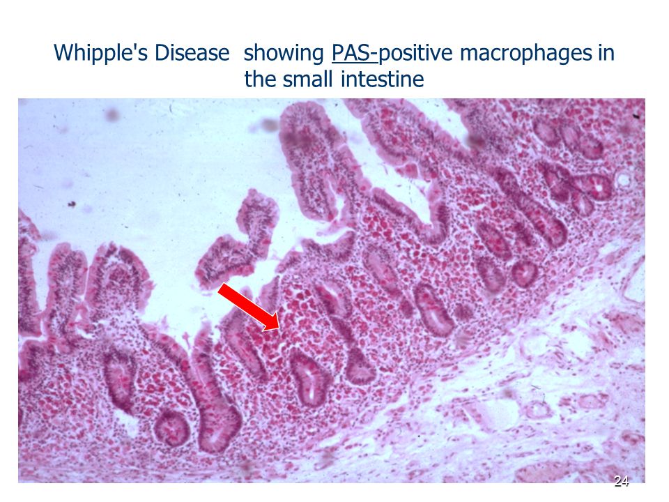 Whipple s Disease showing PAS-positive macrophages in the small intestine