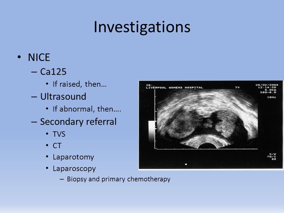 Investigations NICE Ca125 Ultrasound Secondary referral