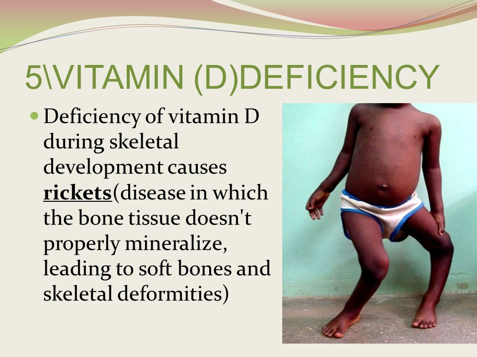 images of vitamin d deficiency diseases
