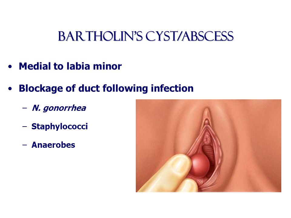 Posterior vaginal wall cyst mimicking rectocele