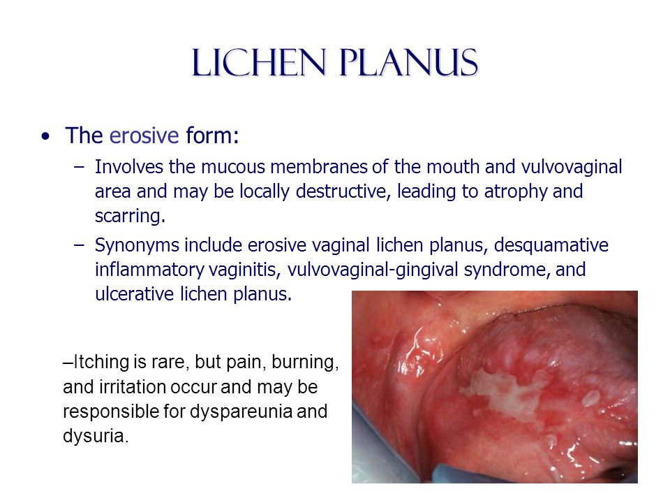 Excision of vaginal and vulvar cysts