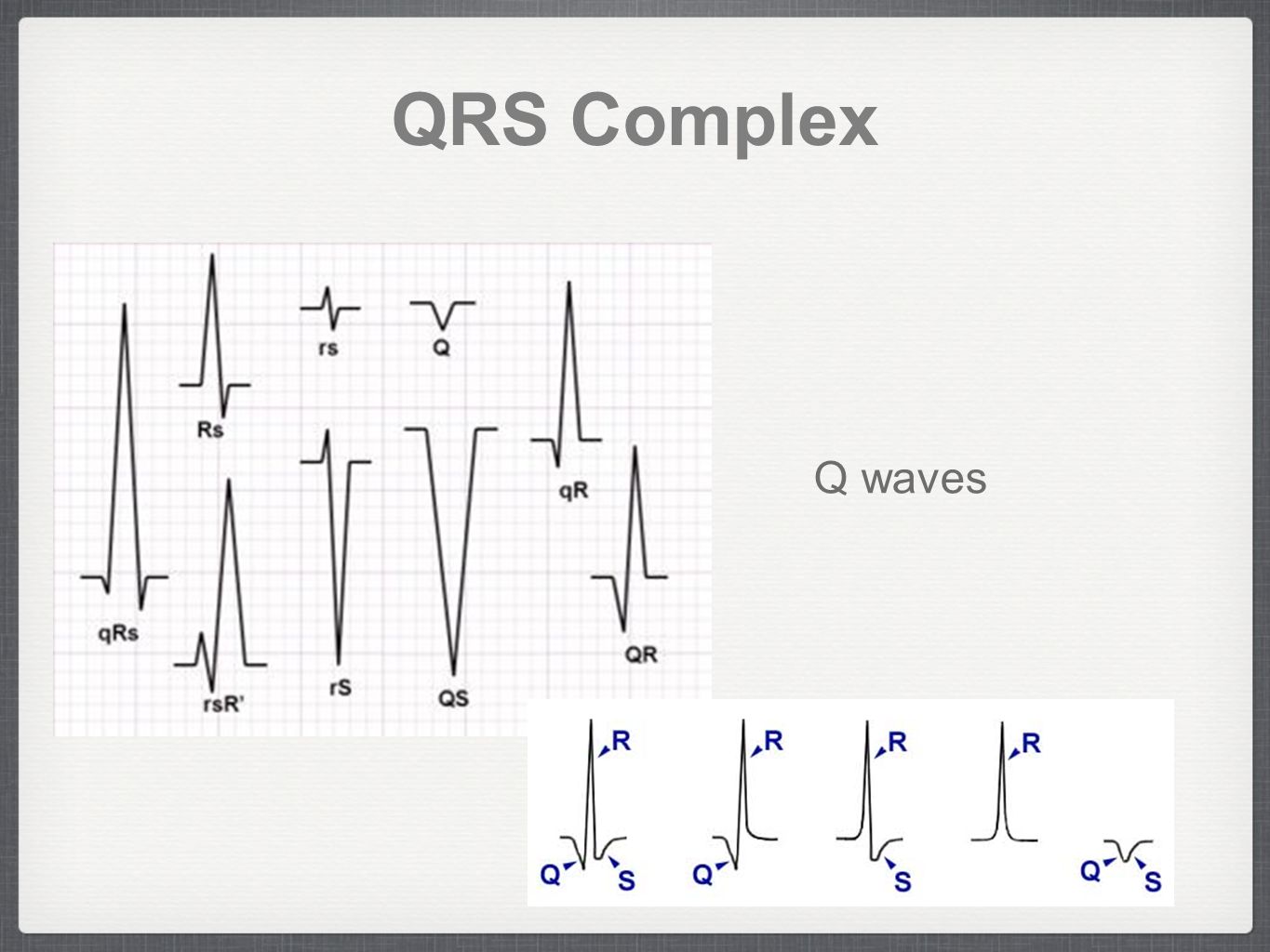 Qrs на экг что это. Комплекс QRS типа RSR. Комплекс QRS на ЭКГ. Комплекс QRS на электрокардиограмме отражает. ECG normal QRS Complex.