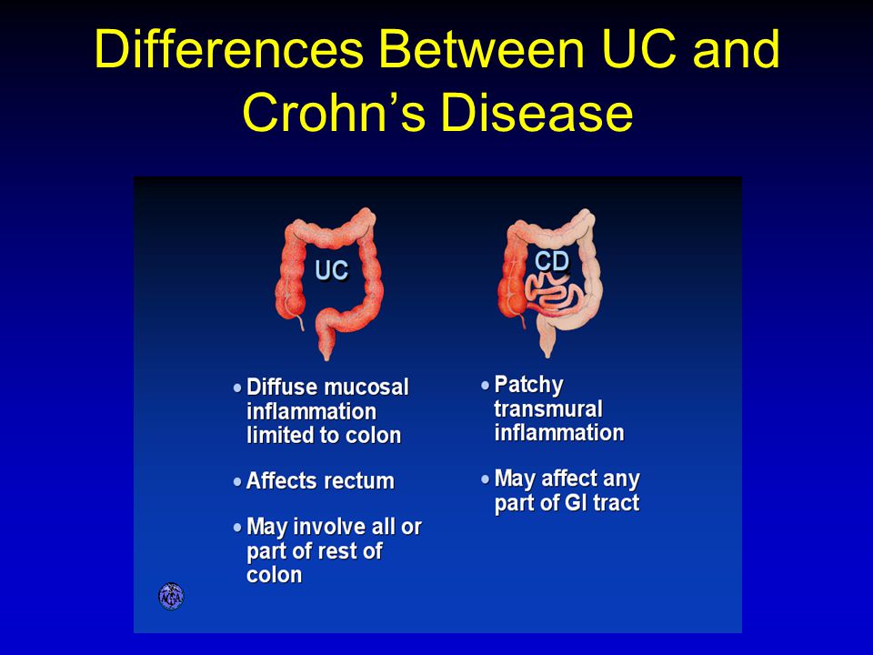 Differences Between UC and Crohn’s Disease