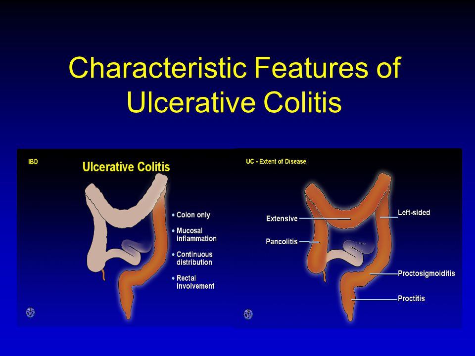 Characteristic Features of Ulcerative Colitis