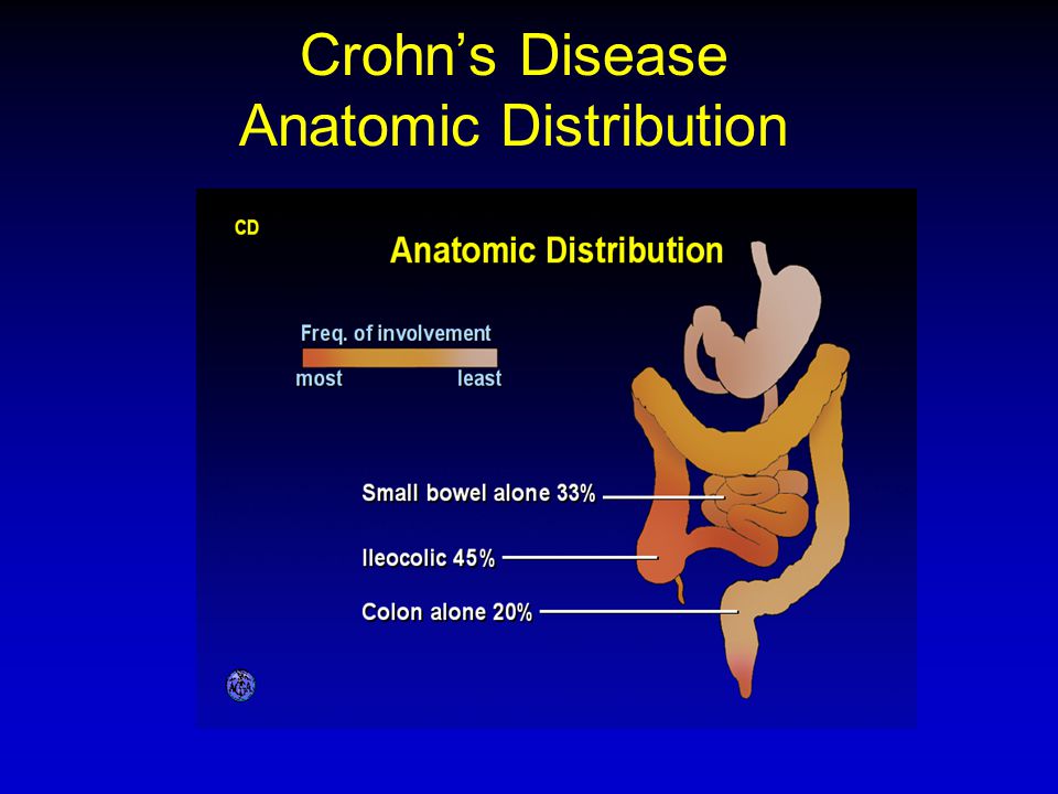 Crohn’s Disease Anatomic Distribution