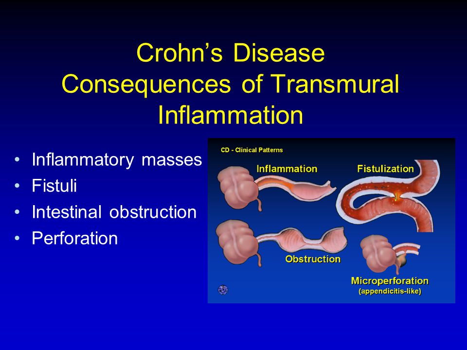 Crohn’s Disease Consequences of Transmural Inflammation