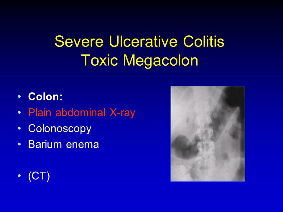 Severe Ulcerative Colitis Toxic Megacolon