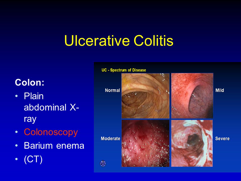 Ulcerative Colitis Colon: Plain abdominal X-ray Colonoscopy