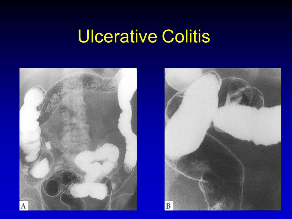 Ulcerative Colitis ב-UC יש כיבים קטנים בתוך הדופן.