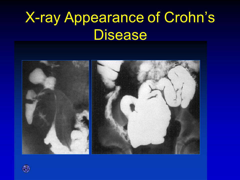 X-ray Appearance of Crohn’s Disease