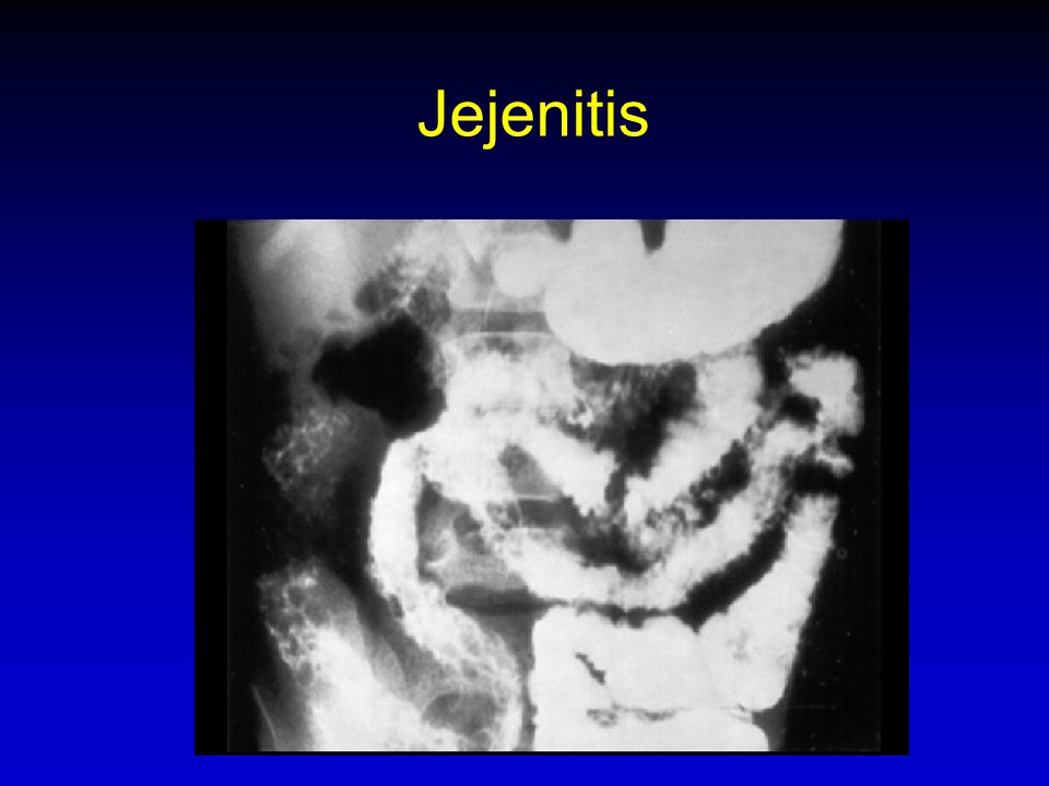 Jejenitis 76. JEJUNITIS.